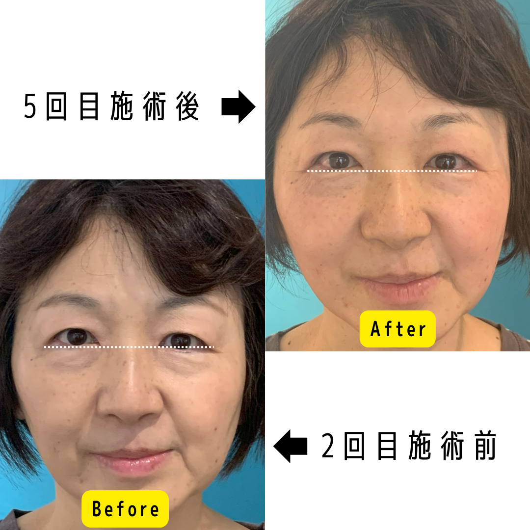 フェイスリフト施術によるBefore/After（複数回施術）