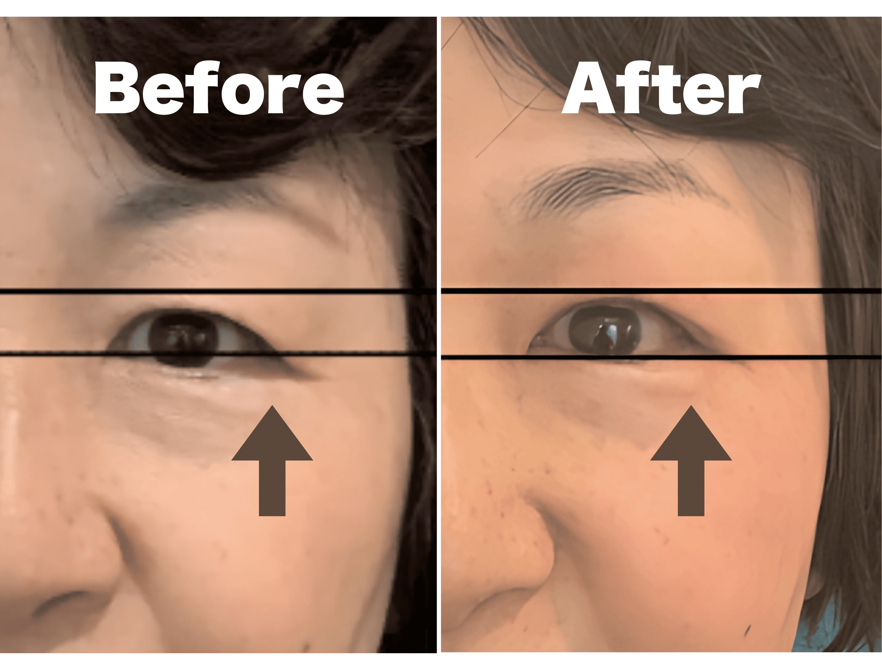 目元のリフトアップ Before/After