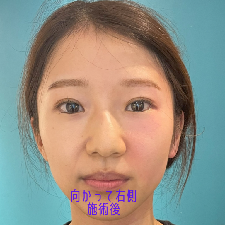 ほうれい線 向かって右側 施術後