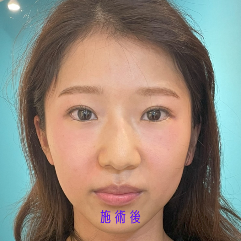ほうれい線 施術後